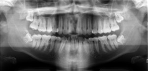 dental-digital-xrays-Basic_panoramic_radiograph
