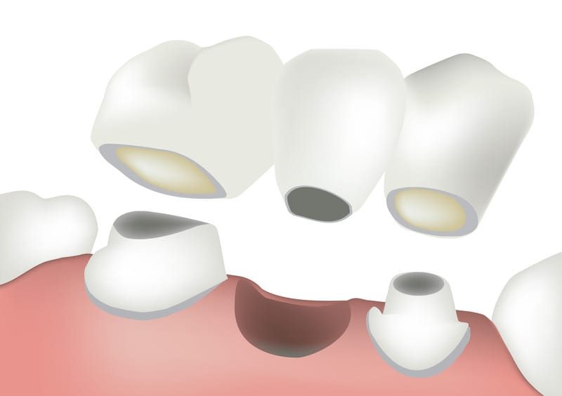 dental bridge boulder