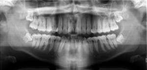 dental-digital-xrays-Basic_panoramic_radiograph