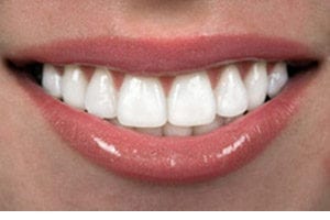 Smile With Teeth 300px 300x200.jpg