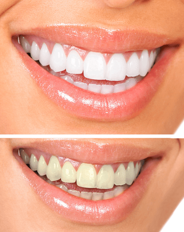 Teeth Whitening Boulder